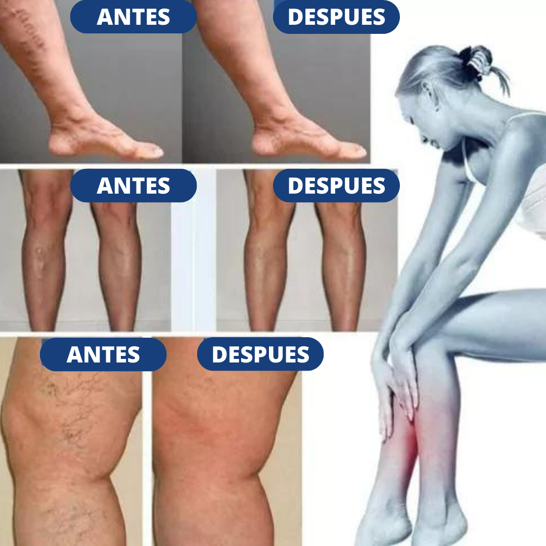 Varipro™ - Parche para Varices ( PACK 10 UNIDADES ) 🎁ESPECIAL CYBERDAYS 2x1🎁