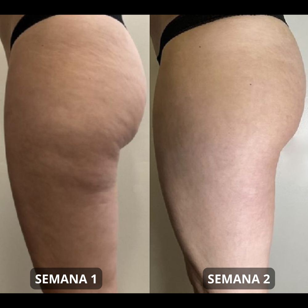 Aceite Anticelulítico para Masajear